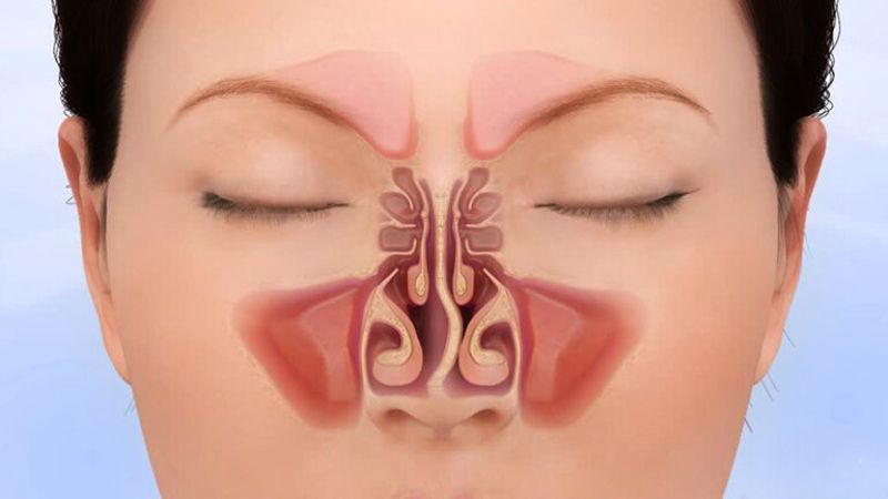 Vách ngăn mũi bị lệch có thể dẫn tới ngủ ngáy Vách ngăn mũi bị lệch có thể dẫn tới ngủ ngáy