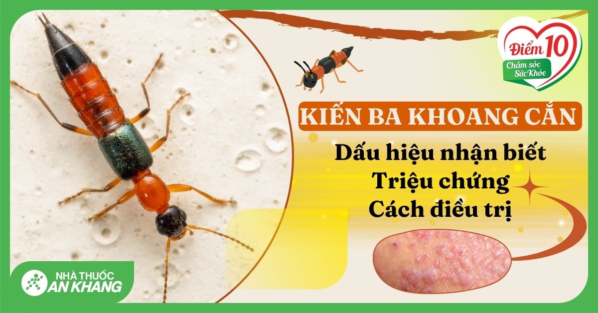Kiến ba khoang cắn: Dấu hiệu nhận biết, triệu chứng, cách điều trị