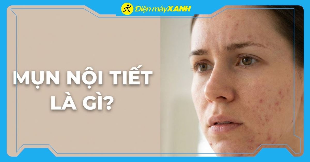 Mụn nội tiết là gì? Dấu hiệu và cách chăm sóc da tại nhà